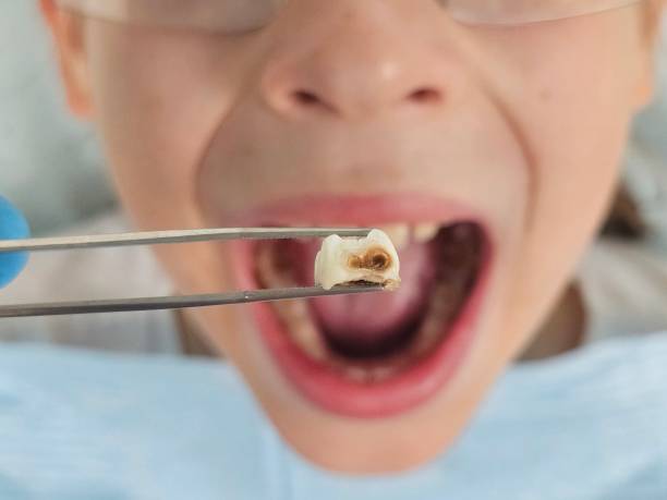 Best Urgent Care for Lost Fillings or Crowns in Coquille, OR
